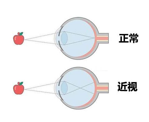 中卫眼科：近视了有哪些矫正措施(图1)