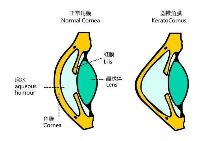甘肃爱尔眼视光盛迅伦团队完成角膜基质透镜植入联合角膜胶原交联术(图5)