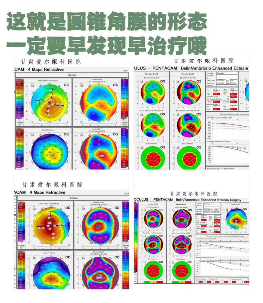 甘肃爱尔眼视光盛迅伦团队完成角膜基质透镜植入联合角膜胶原交联术(图6)