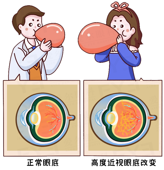 兰州爱尔眼科医院CEO、屈光科主任姚慧科普：超过600度，这些运动尽量不要做(图2)