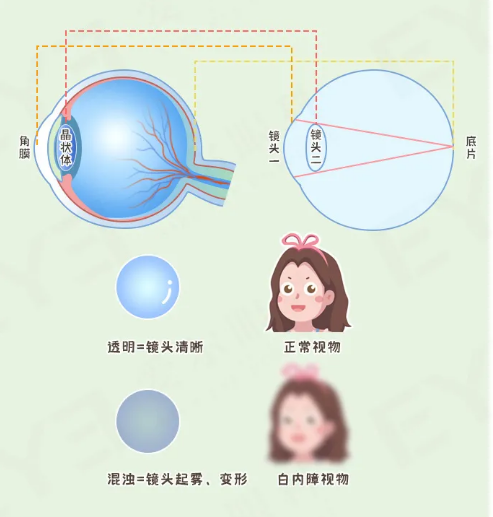 兰州爱尔眼科医院：关于白内障的这些知识，你知道多少?(图1)