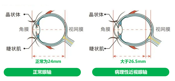 兰州爱尔眼科医院院长陈雪艺：别不当回事，高度近视有可能致盲(图3)