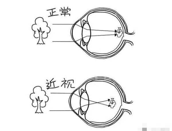 甘肃眼科：全飞秒激光手术有三大优势是什么(图1)