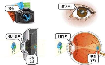 白内障2.jpg