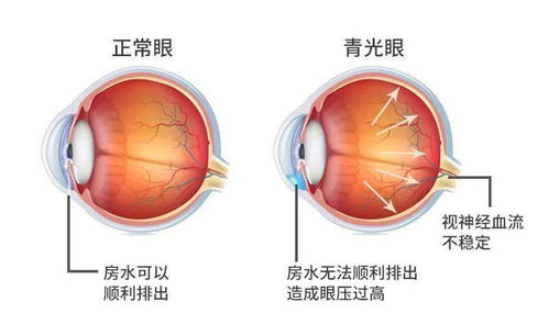 医生说眼病丨青光眼就是眼压高?(图1) 医生说眼病丨青光眼就是眼压高?(图1)