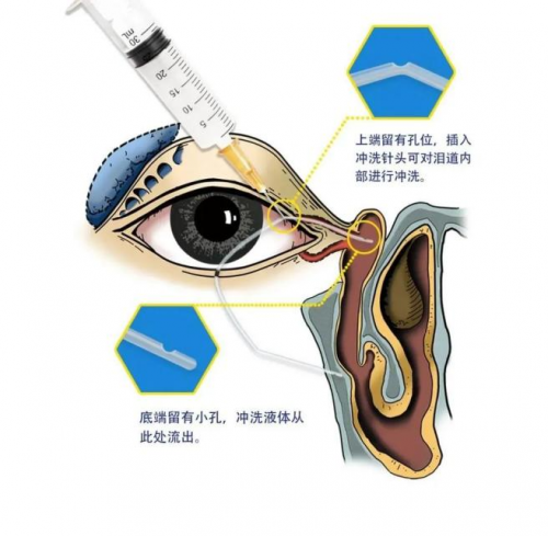 兰州爱尔范好荣主任提醒：莫名其妙流泪可不是小事！(图2)