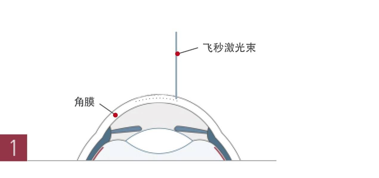 兰州爱尔眼科医院姚慧院长：近视眼手术“火”，为啥戴眼镜的医生自己很少做(图4)