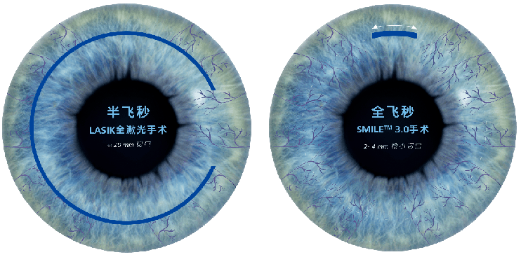 兰州爱尔眼科医院姚慧院长:全飞秒手术中忍不住想眨眼，怎么办(图2)