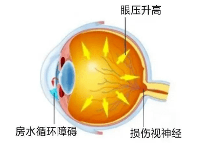 兰州爱尔眼科医院韦萍院长：关于青光眼，这些事你可能不知道(图1)